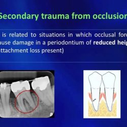 Primary vs secondary occlusal trauma