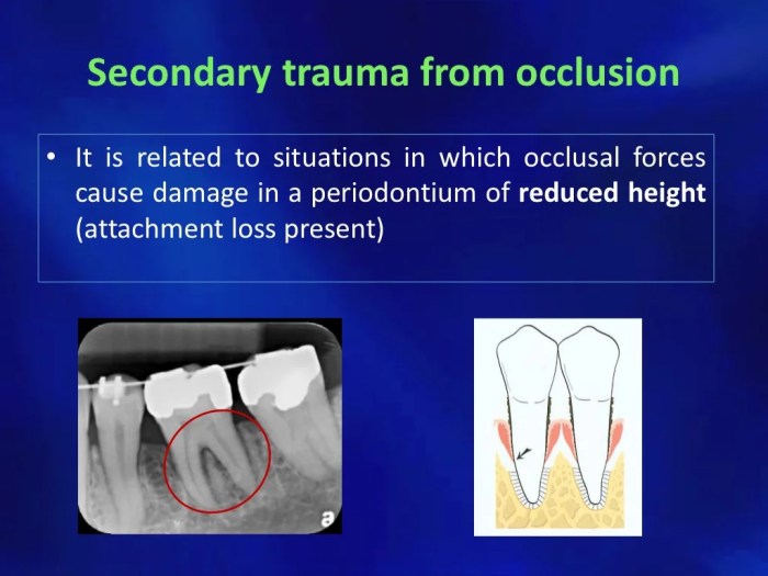 Primary vs secondary occlusal trauma